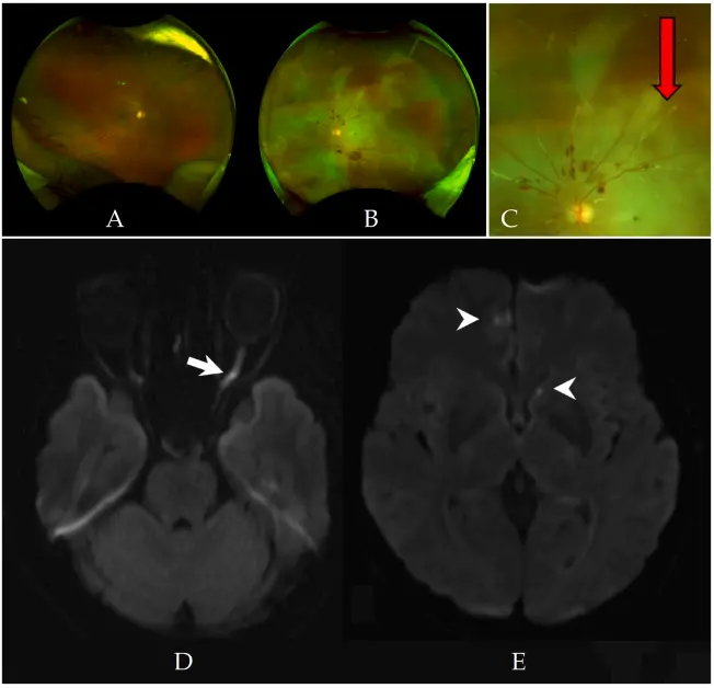 童顏針（PDLLA），又一例栓塞致盲案例來了