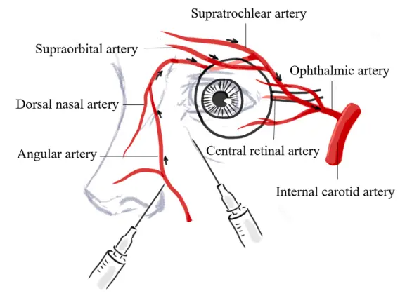 童顏針（PDLLA），又一例栓塞致盲案例來了
