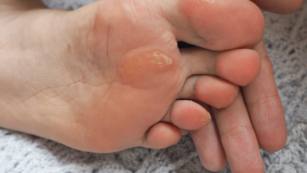 液氮凍雞眼注意事項(xiàng)