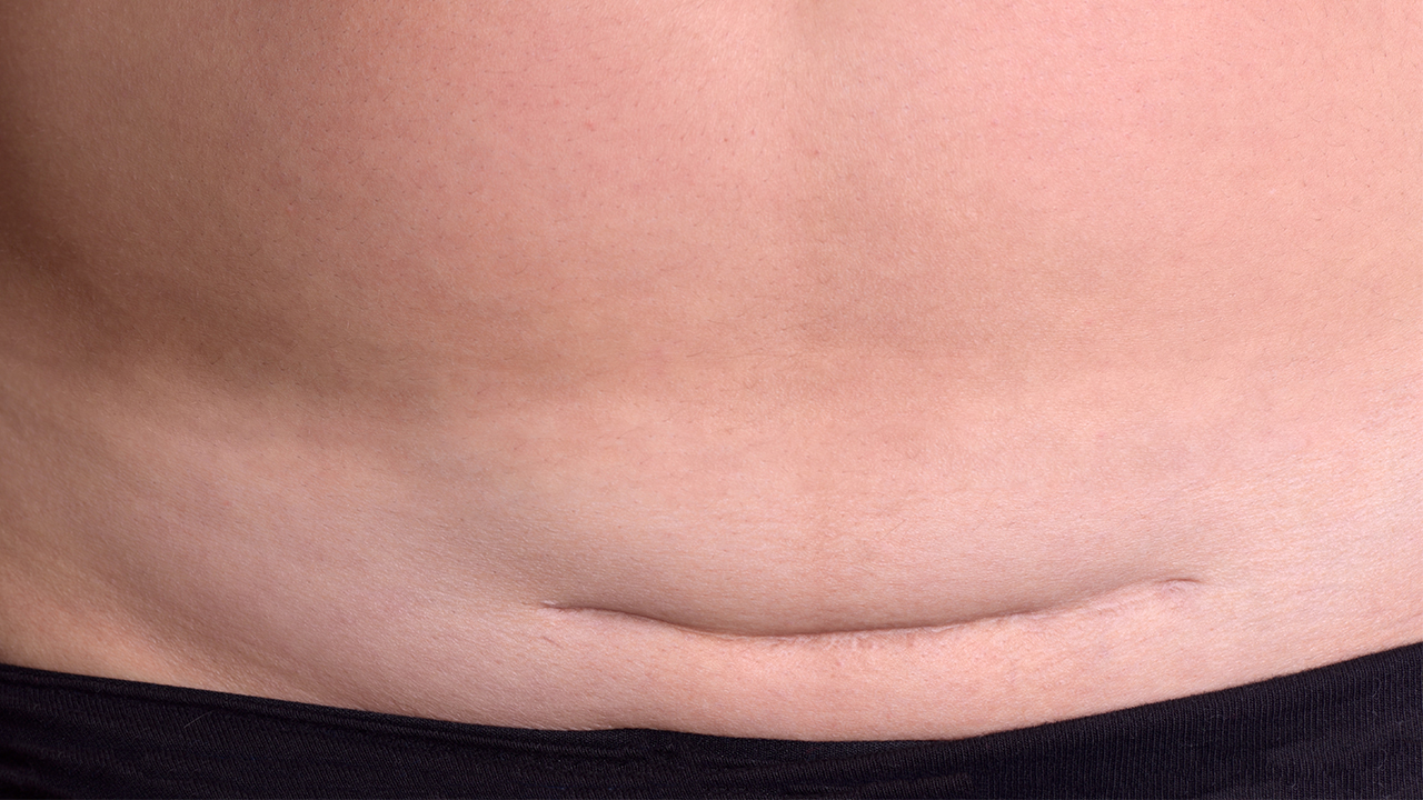 腋窩狐臭手術(shù)疤痕怎么去除