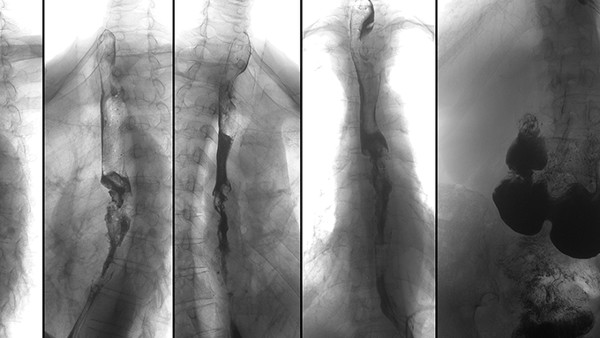 強直性脊柱炎的危害很大嗎