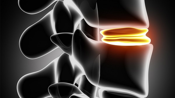 強直性脊柱炎應(yīng)該注意什么