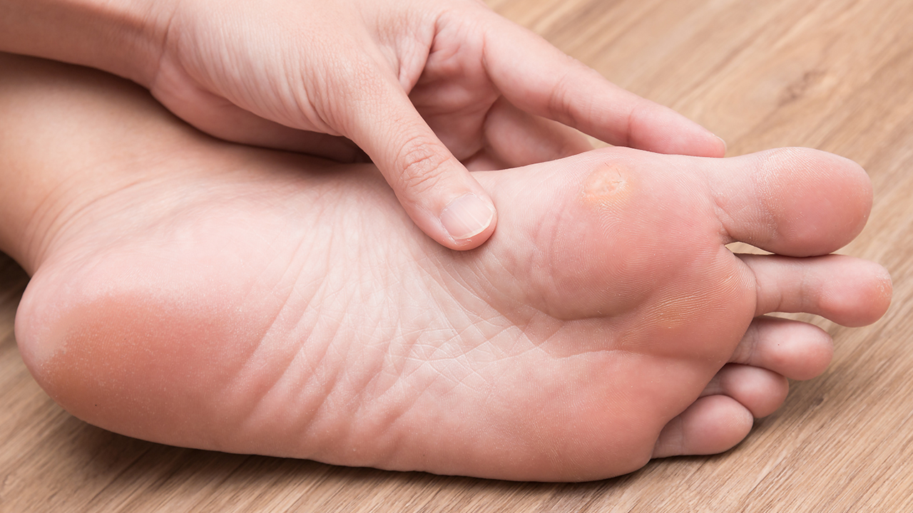 怎么可以把雞眼消掉