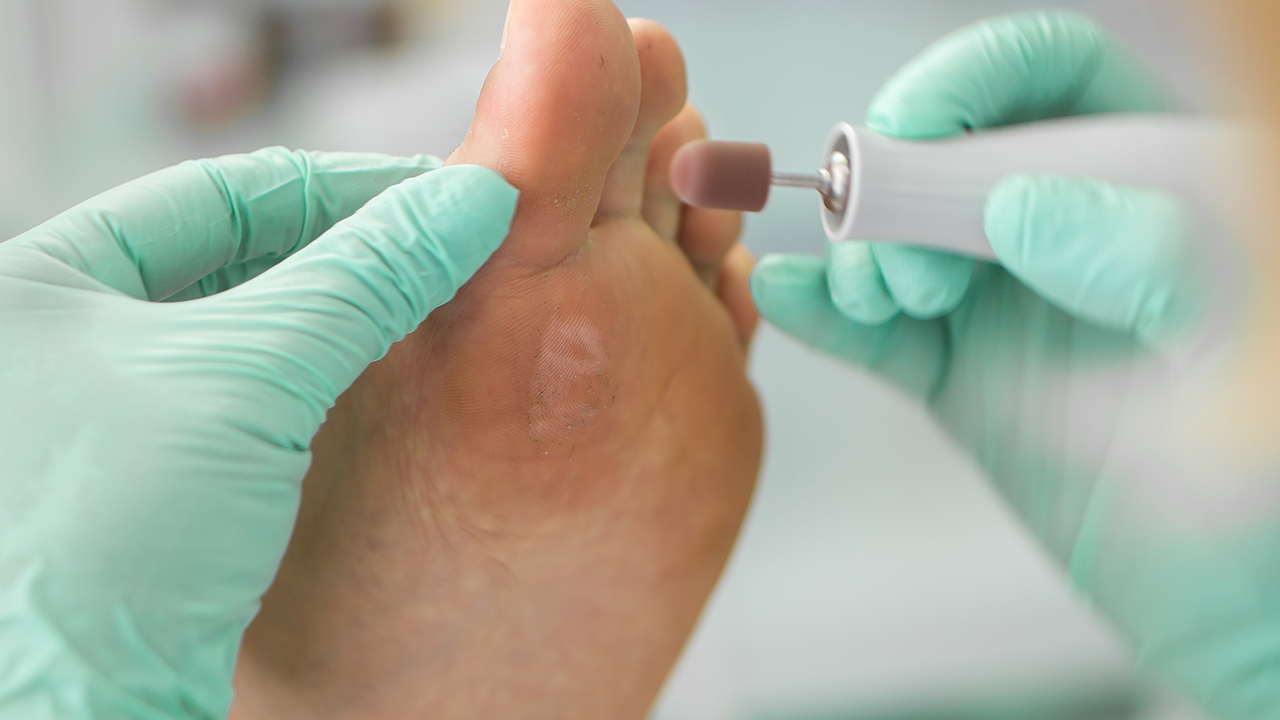 小孩子手上長個雞眼