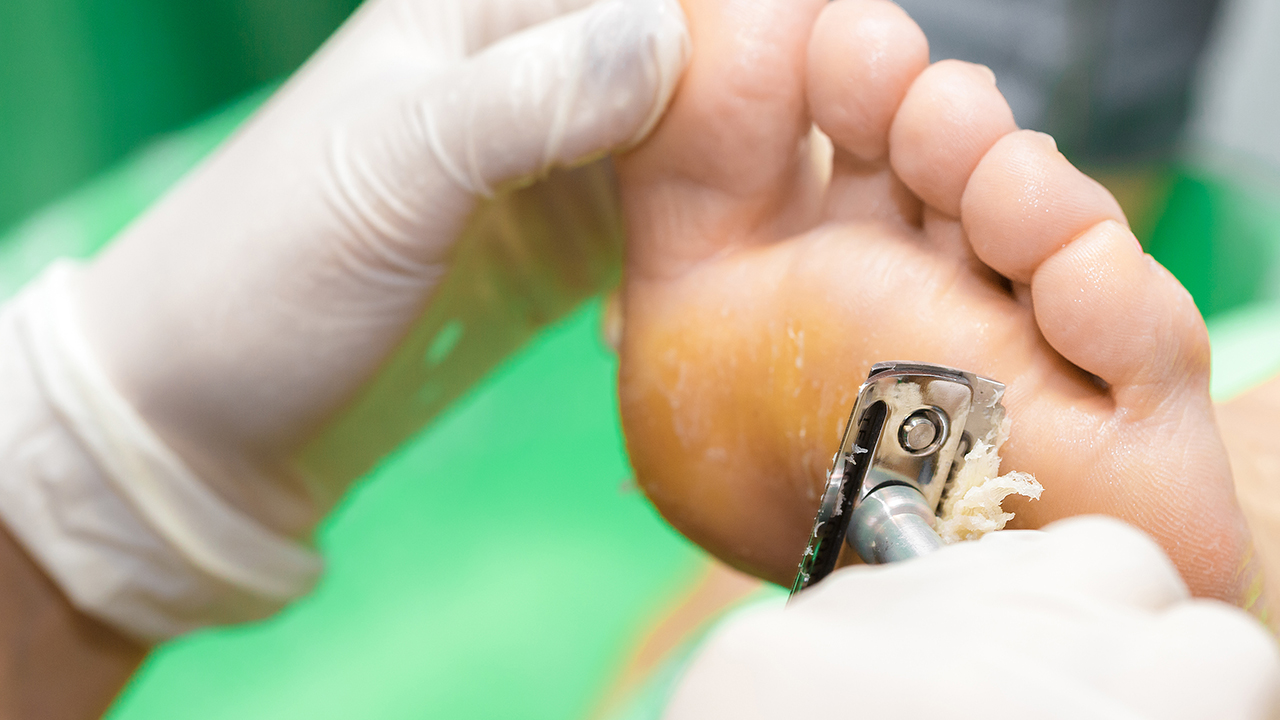 血刺疣和雞眼的區(qū)別