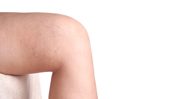 患滑膜炎膝關(guān)節(jié)疼痛怎么辦