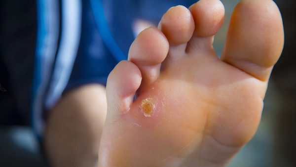 怎么看還有沒有雞眼