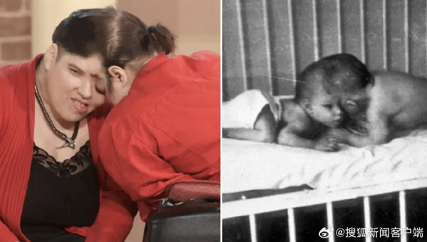 世上年長(zhǎng)連體雙胞胎去世 終年62歲：一個(gè)做過(guò)變性手術(shù) 一個(gè)有未婚夫