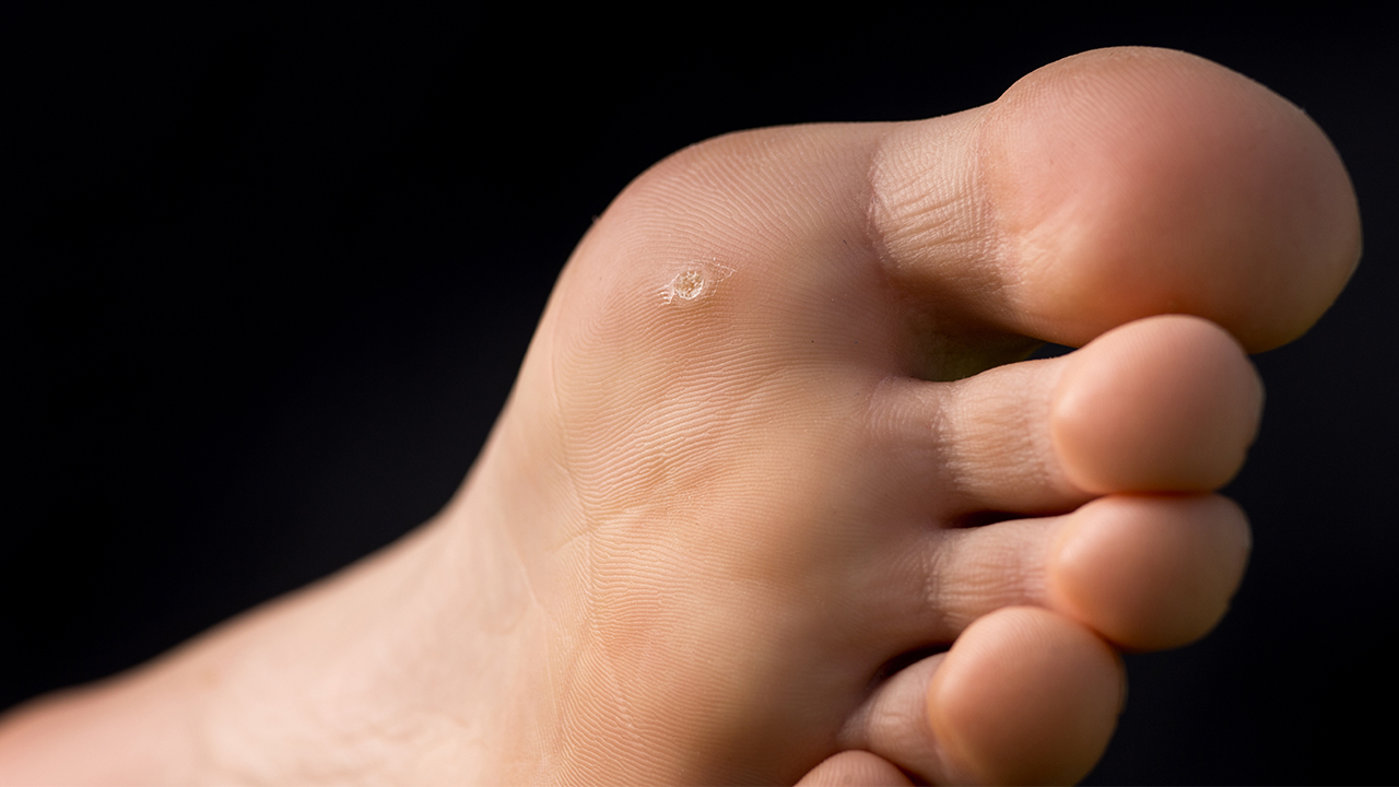 血胞刺跟雞眼一樣嗎