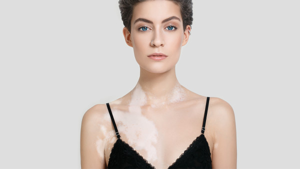 引起白癜風(fēng)的因素有哪些