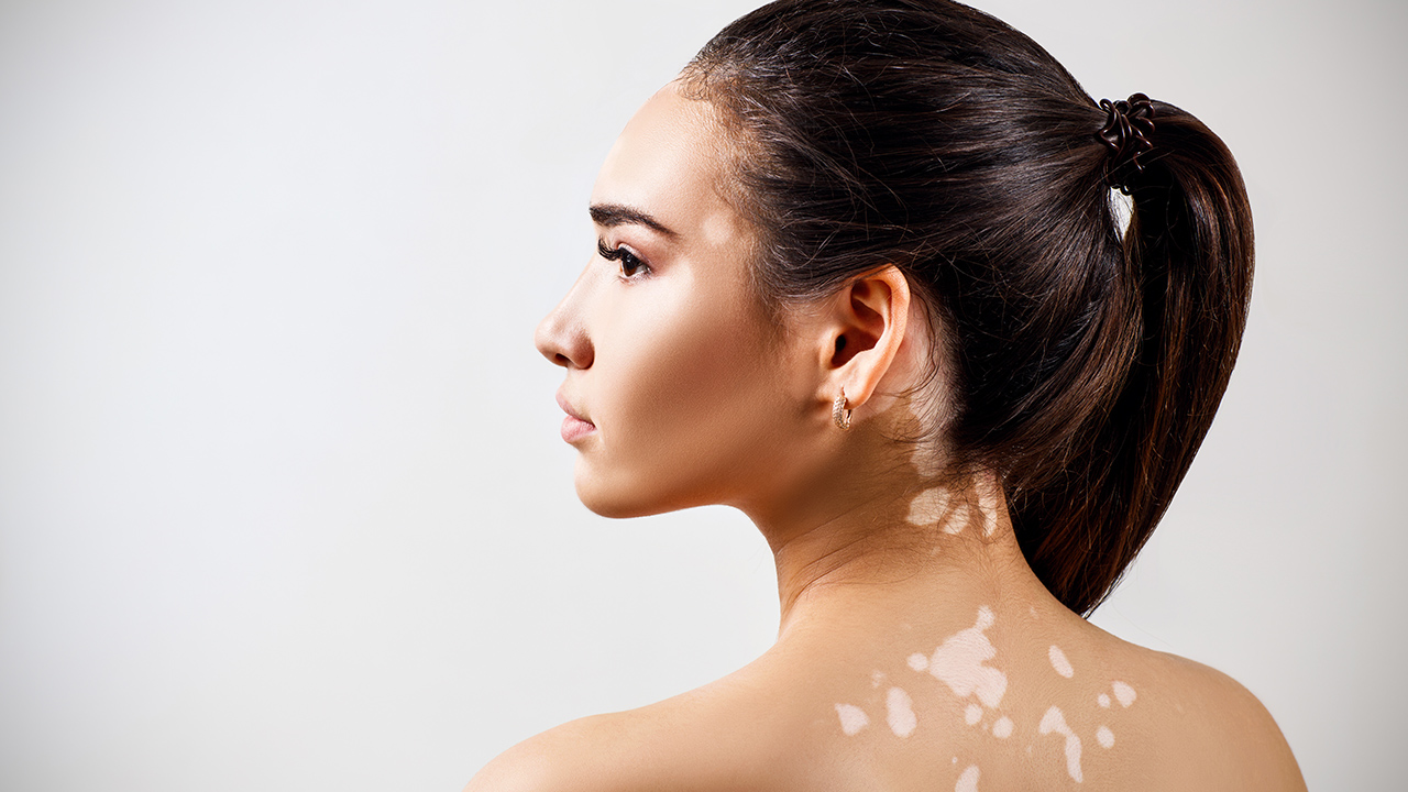 白癜風(fēng)復(fù)發(fā)了應(yīng)該怎么辦