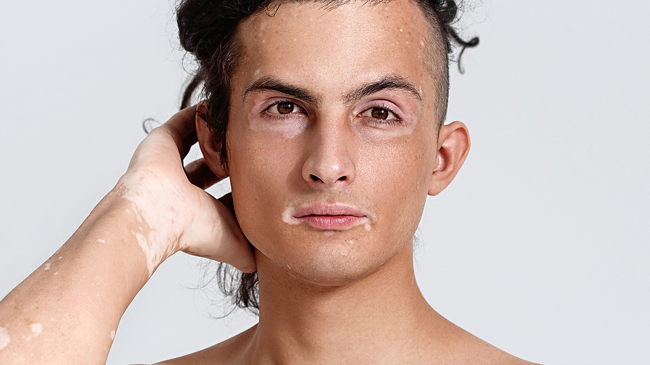 白癜風患者可以做美容嗎