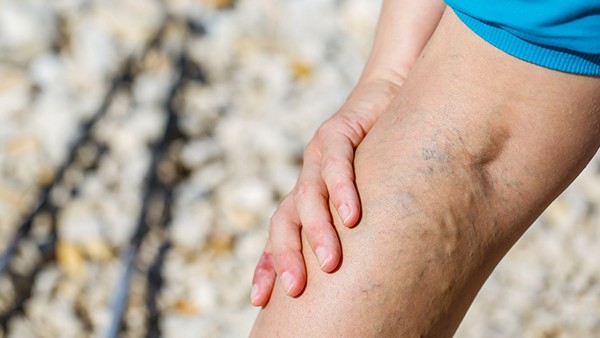 靜脈曲張是什么原因造成的