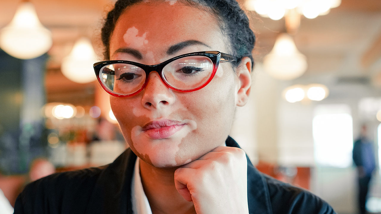 白癜風的日常護理是什么