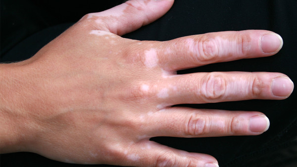 冬季白癜風(fēng)平時該做什么