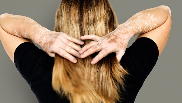 秋季怎么護(hù)理白癜風(fēng)患者