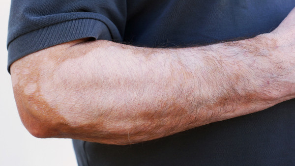 白癜風(fēng)患者什么魚不能吃