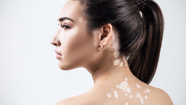 胳膊上的白癜風(fēng)如何治呀