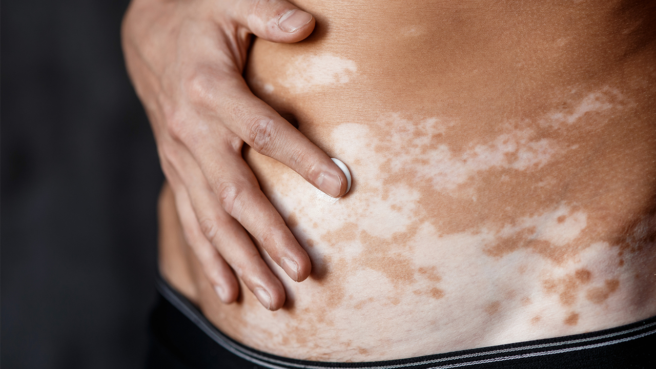 腰部白癜風(fēng)怎么治療的好