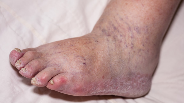 62歲有高血壓心絞痛能爬山嗎？