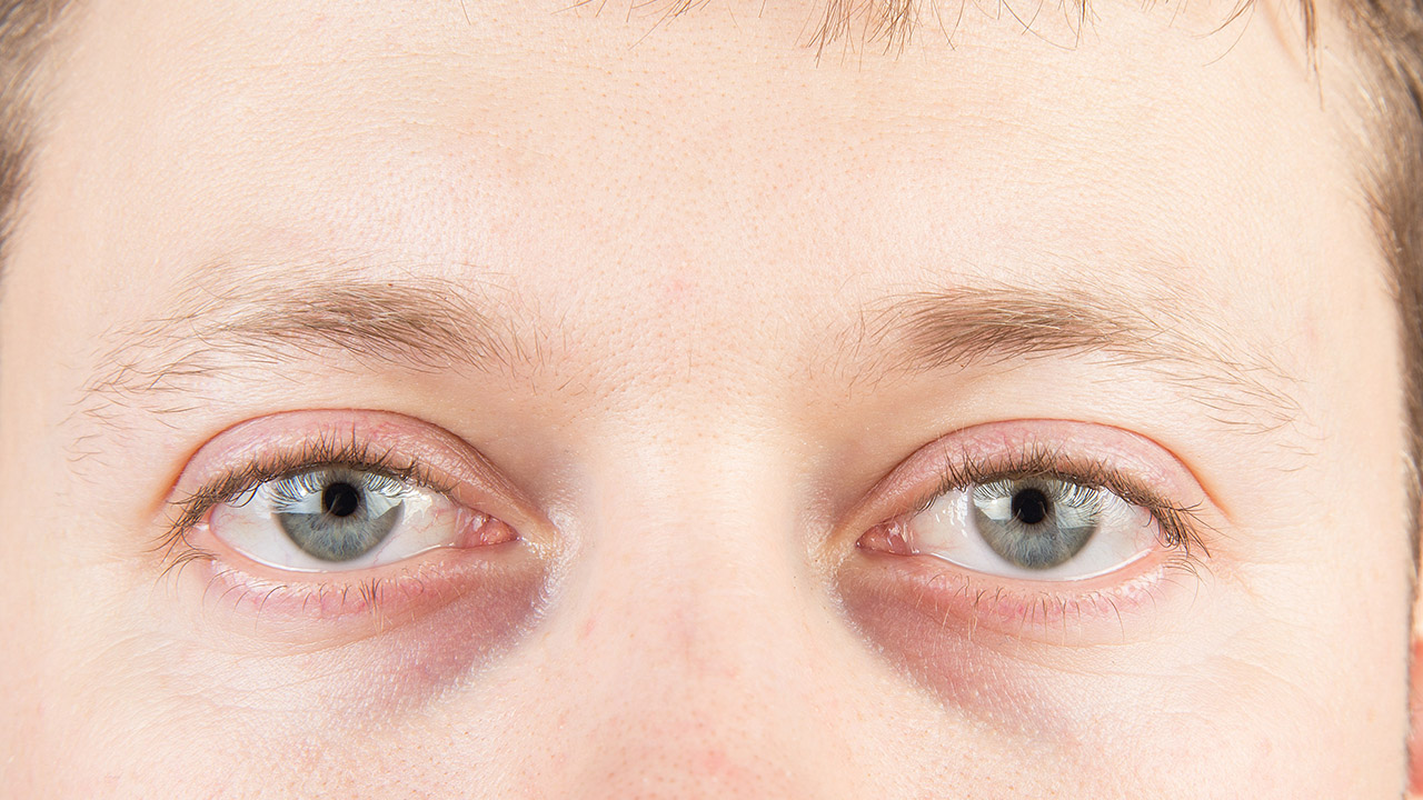 2型糖尿病性低血糖性昏迷有哪些典型癥狀