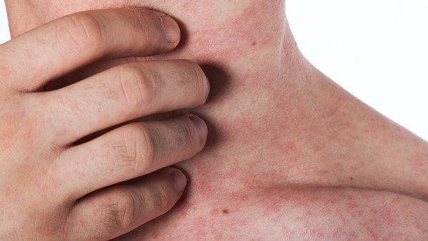 艾滋病患者頭暈是晚期嗎？