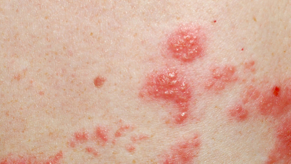 大部分艾滋病正常壽命