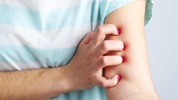 登革熱被蚊子咬了有紅點(diǎn)