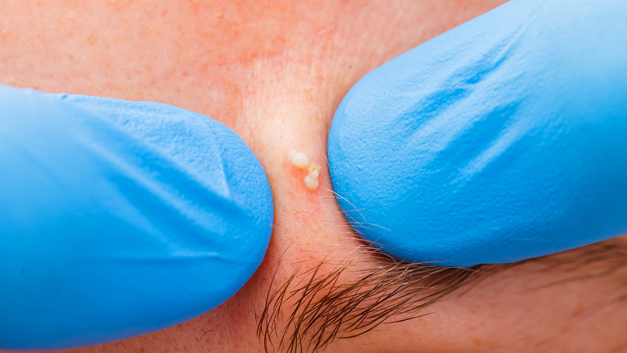 腋窩長(zhǎng)小痘痘是狐臭嗎嗎