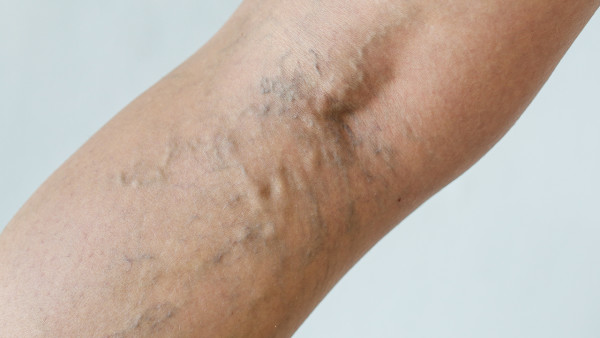 靜脈曲張會便血么