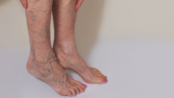 靜脈曲張會出血嗎