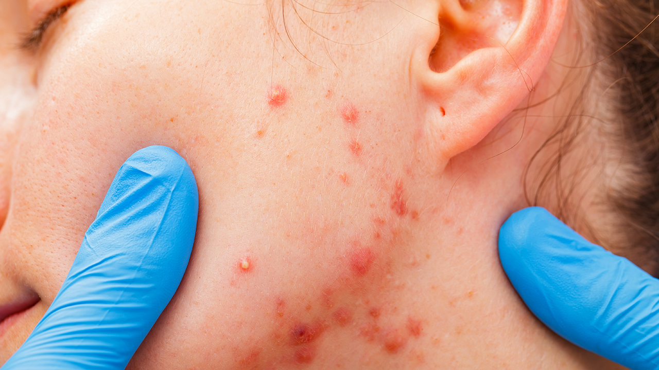 腋下汗味重怎么辦和狐臭