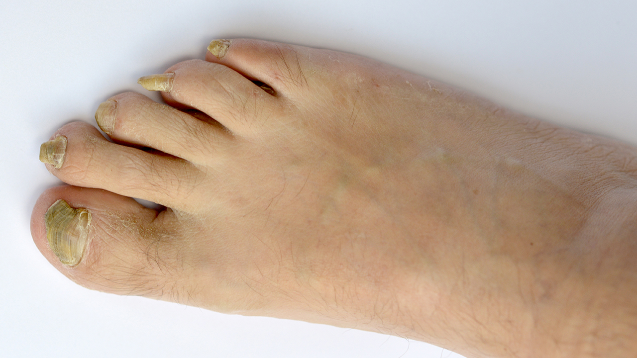 甲溝炎可不可以手術(shù)治療