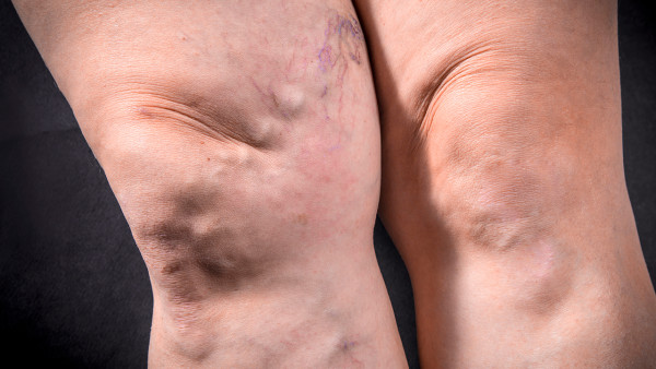 嚴重類風濕算殘疾嗎