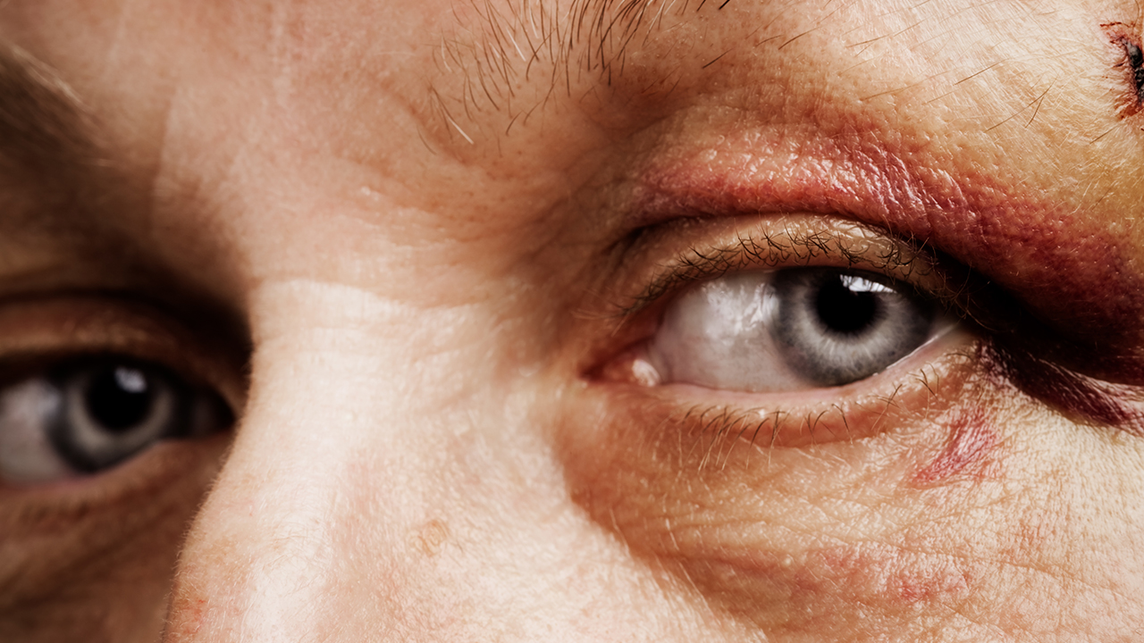 眼距寬能做內(nèi)斜視手術(shù)嗎