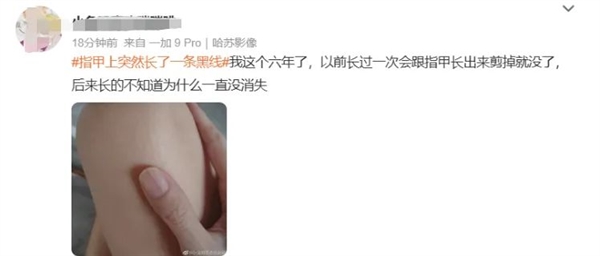 指甲出現(xiàn)一條黑線 別不當(dāng)回事！可能是癌變