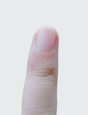 指甲出現(xiàn)一條黑線 別不當(dāng)回事！可能是癌變