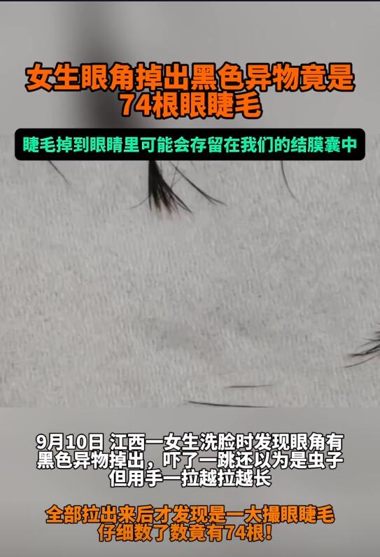 醫(yī)生回應(yīng)女子眼角掉出74根眼睫毛：如有不適 建議檢查