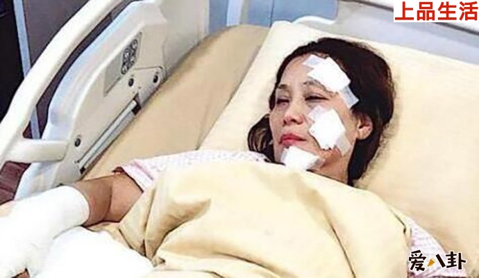 楊盼盼片場(chǎng)燒傷怎么回事