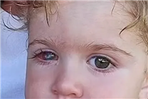 1歲多寶寶疑被大人親吻后失明 醫(yī)生：感染皰疹病毒致眼角膜穿孔